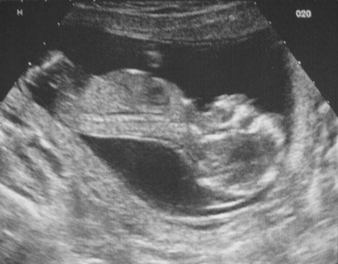 FR 15 Week Scan